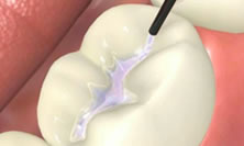 Pacientes con Fisura Labio-Alveolo-Palatina