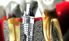 Implantes Dentales